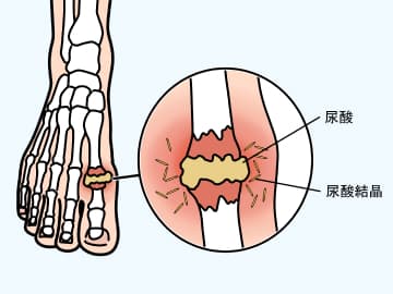 高尿酸血症とは